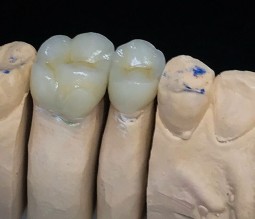 Porcelain Crowns