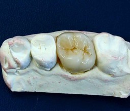 molar porcelain crown